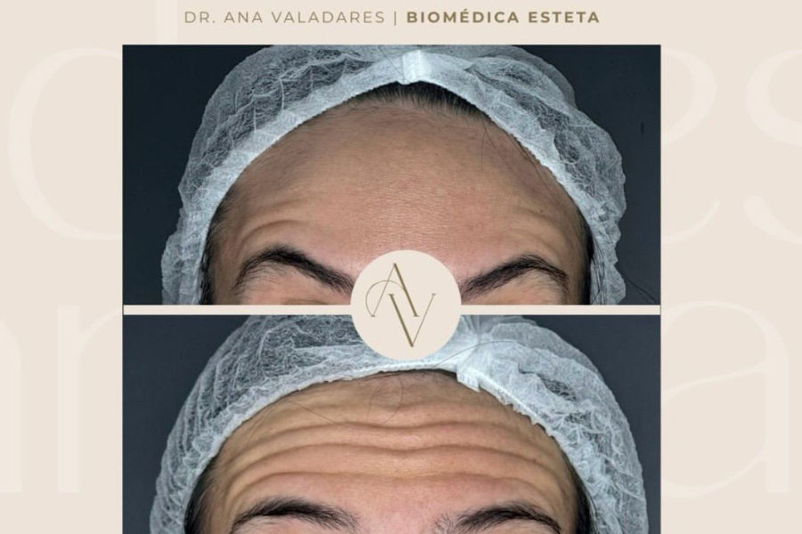 Toxina Botulínica